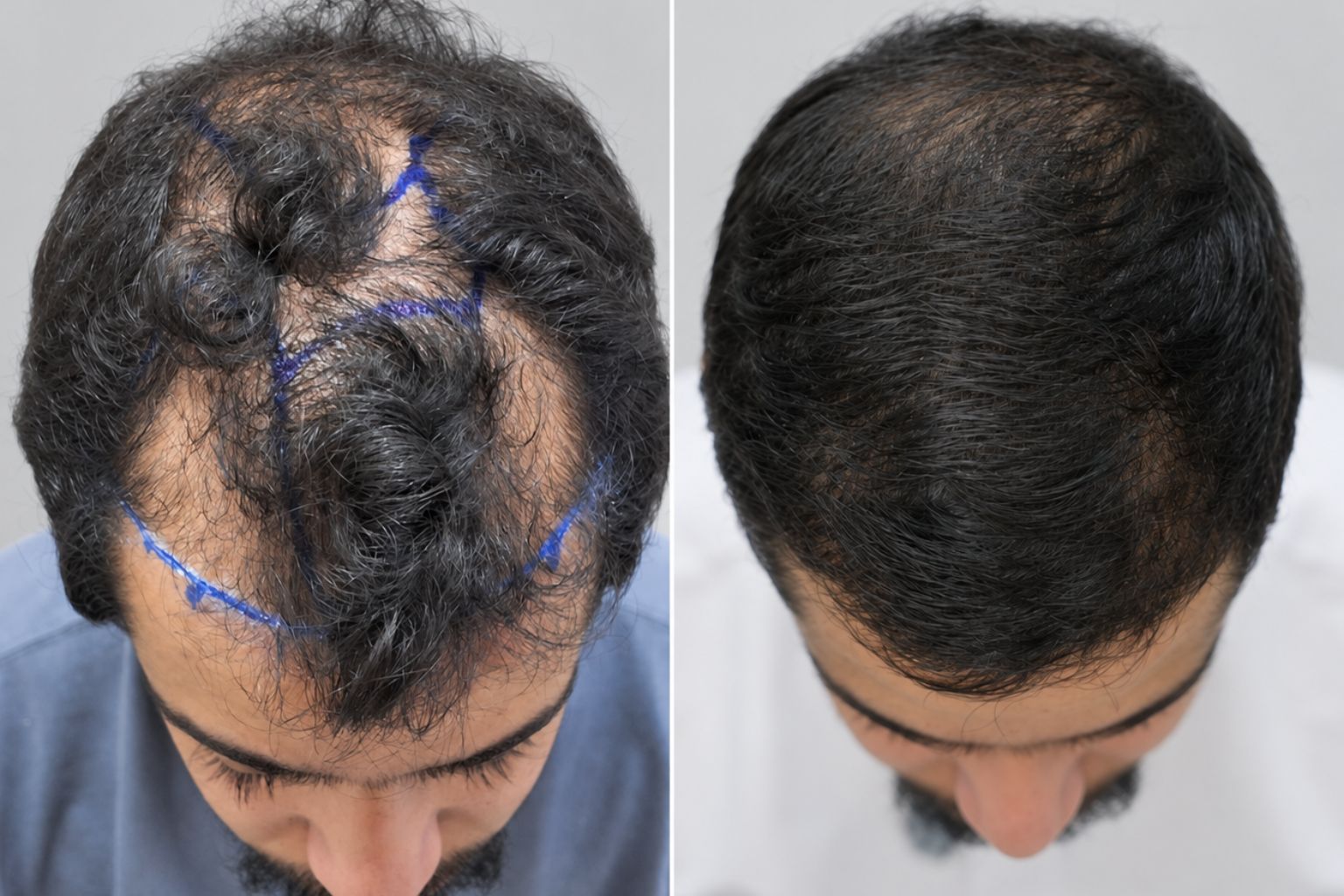 زراعة الشعر في ستوراكس — قبل وبعد: استعادة كثافة الشعر بالكامل في منطقة تاج الرأس.
