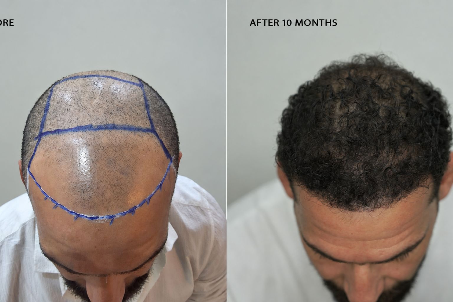 زراعة الشعر في ستوراكس — قبل وبعد: تعزيز كثافة خط الشعر وتغطية المنطقة الأمامية.