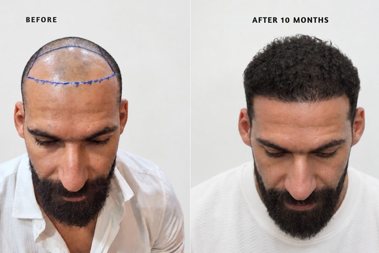 زراعة الشعر في ستوراكس — قبل وبعد: استعادة خط الشعر المتراجع ومنطقة الصدغين.