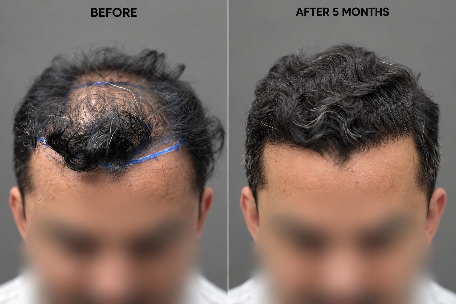 زراعة الشعر في ستوراكس — قبل وبعد: بداية ظهور نمو الشعر وإعادة تصميم خط الشعر الأمامي.