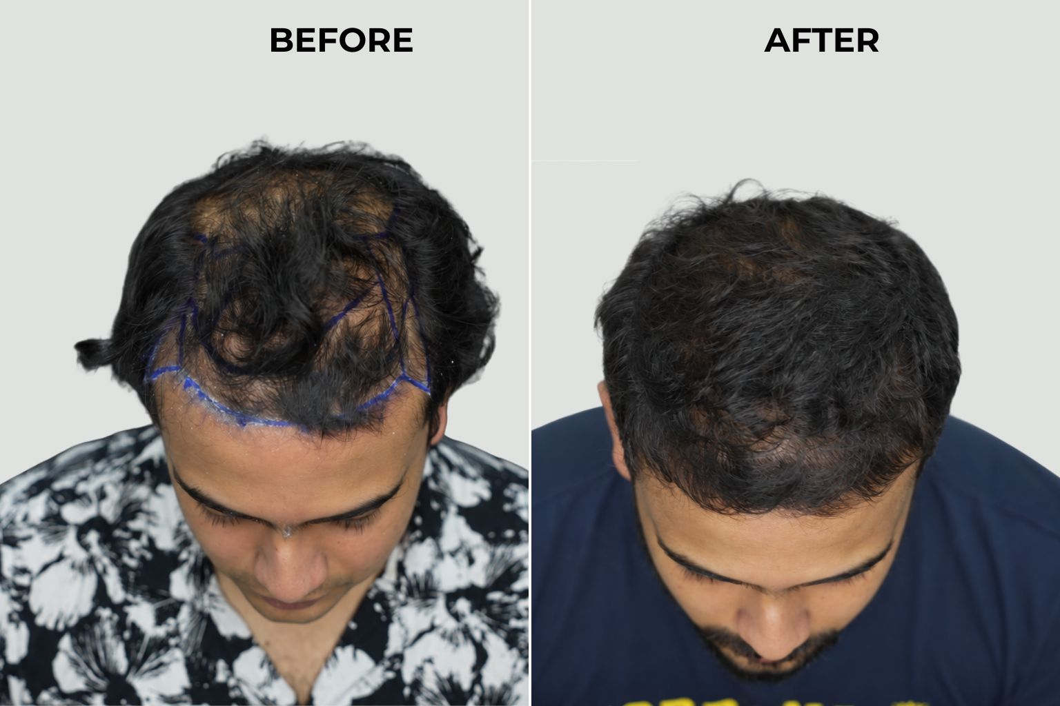 زراعة الشعر في ستوراكس — قبل وبعد: زيادة شاملة في كثافة تاج الرأس وخط الشعر.