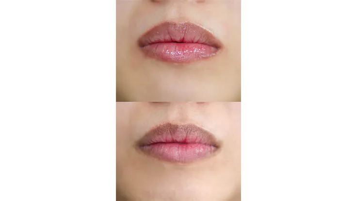 Laser treatment in Dubau