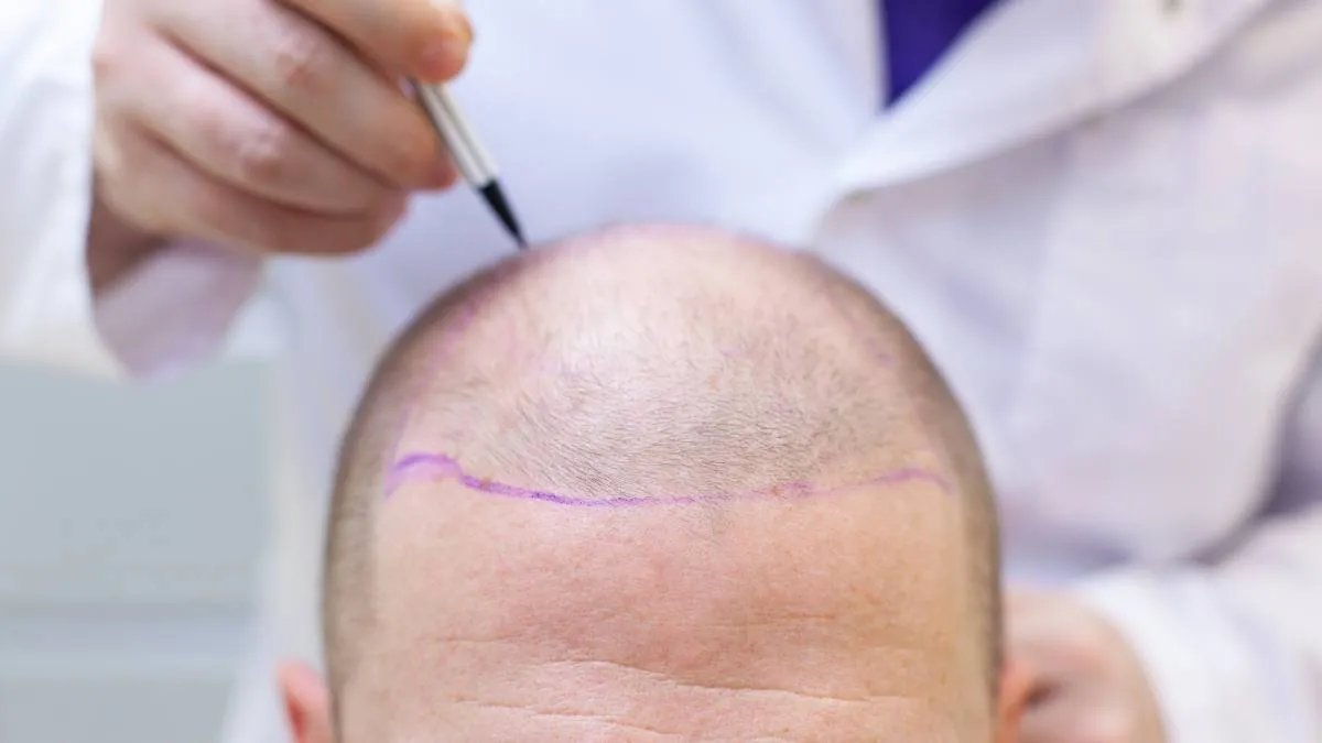 Hair Transplant Blog Banner