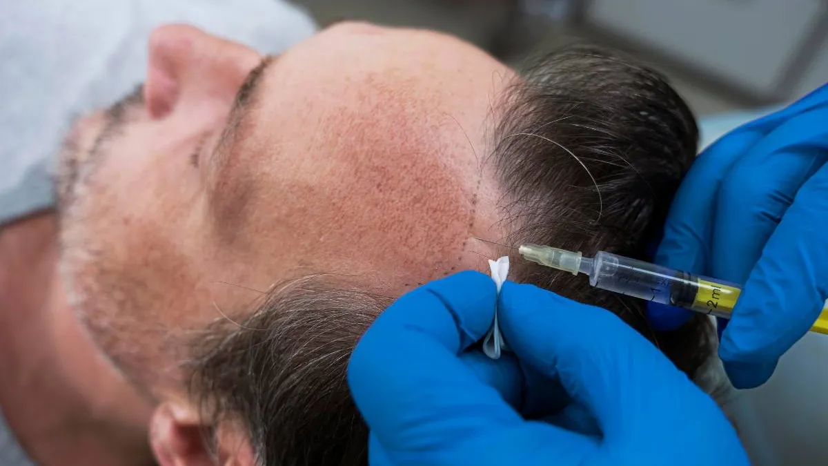 Latest Hair Transplant Techniques Blog