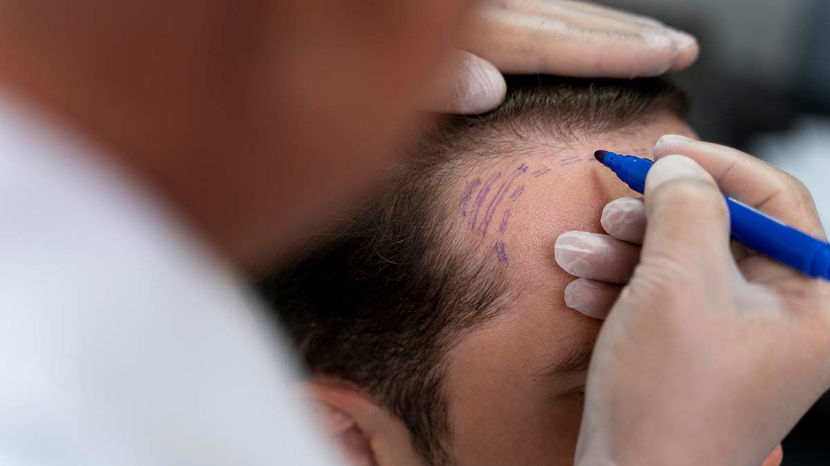 Scalp Micropigmentation